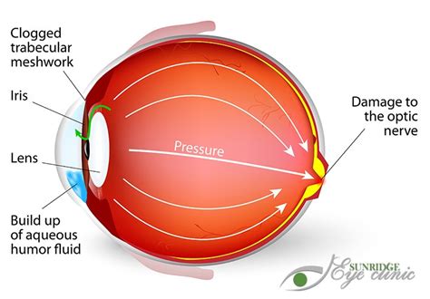 Symptoms Diagnosis And Treatment Of Glaucoma Sunridge Eye Clinic