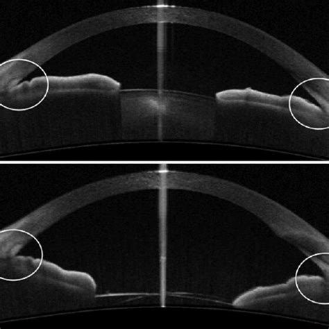 A Anterior Segment OCT Of An Angle Closure Glaucoma With Narrow Angles