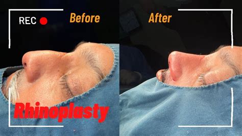 Best Rhinoplasty In Lahore Rhinoplasty Best Plastic Surgeon In