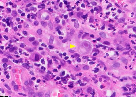 Pathology Outlines Cmv