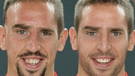 Franck Ribéry E Ronaldinho Gaúcho Passam Por ‘plástica’ Facial Veja Transformações