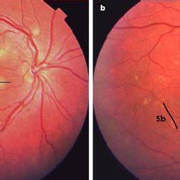 Fundus Photo A Showing Characteristic Lesions Of The Acute Phase