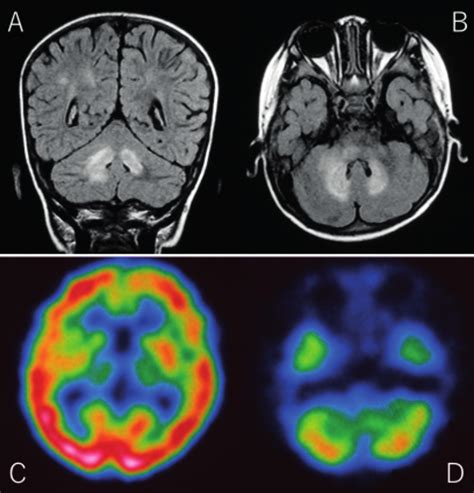 MRI And SPECT Imaging A B On Day 23 MRI FLAIR Images Revealed High