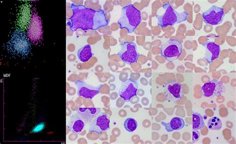 Atypical Lymphocyte Ebv