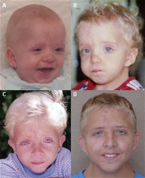 Noonan Syndrome On Emaze