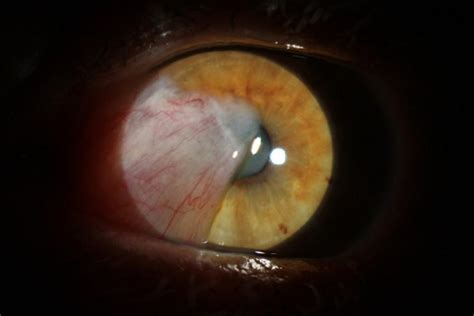 What causes eye cataracts?: Lowcountry Eye Specialists : Ophthalmologists