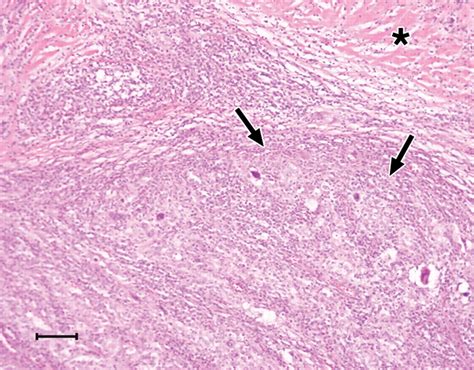 Medullary Carcinoma Of The Breast Mri Findings Ajr