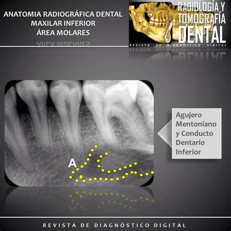 Maxilar Inferior Rea Molares Anatom Adentaria Radiografiadental