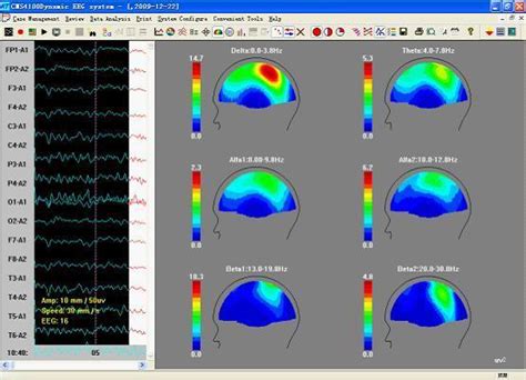 Contec Cms4100 Portable Dynamic Eeg System 16 Channel 24 Hour Carrying