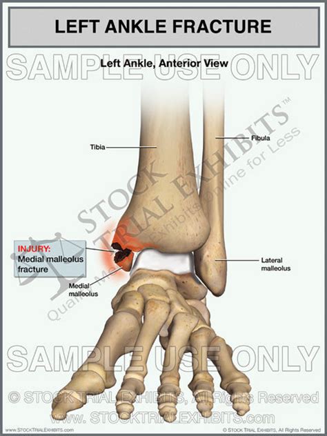 Ankle Fracture of the Left Medial Malleolus Fracture – Stock Trial Exhibits