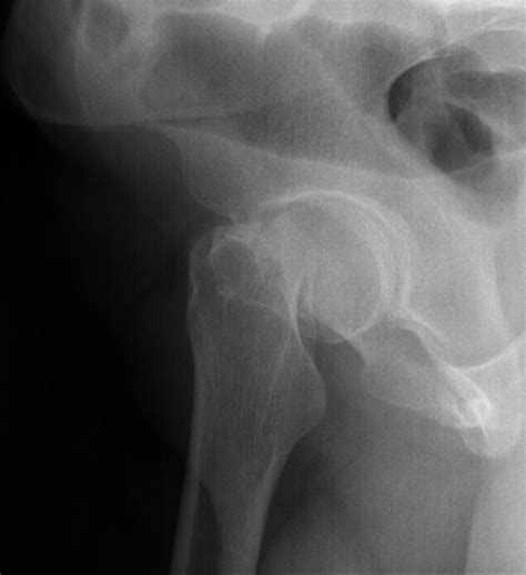 Bilateral Simultaneous Femoral Neck Fractures Image Radiopaedia Org