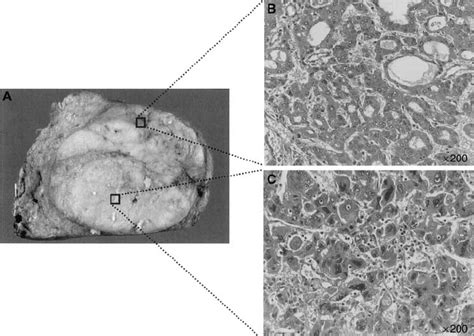 Macroscopic And Microscopic Features Of Hcc Showing A Nin Appearance Download Scientific