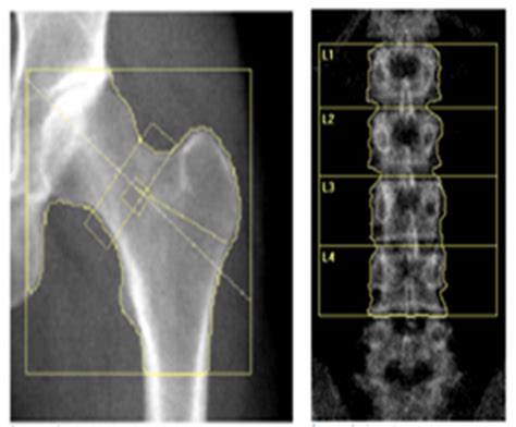 Bone Density Scan Results / Bone densitometry - The more bone material ...