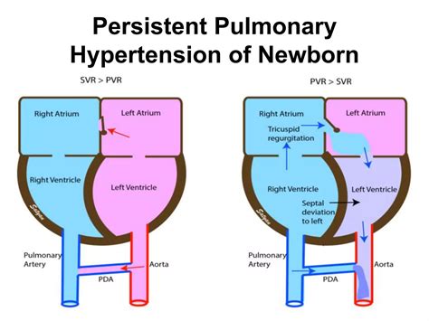 Meconium Aspiration Syndrome Ppt