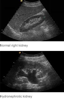 Normal Kidney Ultrasound