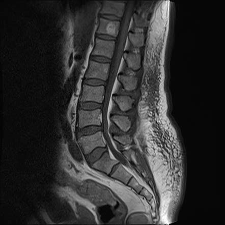 Vertebral hemangioma | Image | Radiopaedia.org