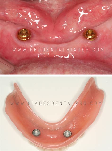 Pr Tesis Sobre Implantes Y Locator En Cl Nica Dental Prodental Hiades