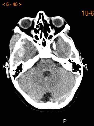 The Radiology Assistant Traumatic Intracranial Hemorrhage