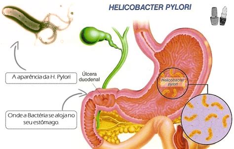 Bact Ria H Pylori