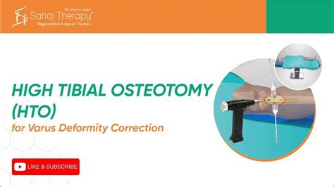 High Tibial Osteotomy Hto Surgery Youtube