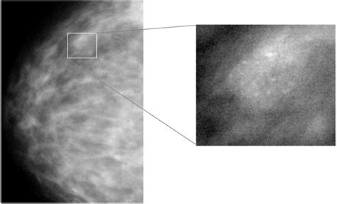 Left Mammogram In Craniocaudal View Right Expanded View Showing