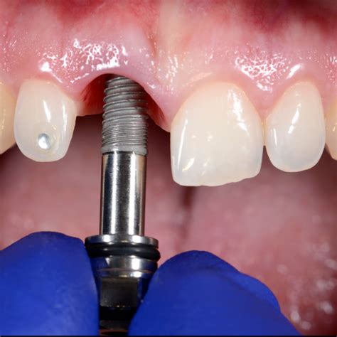 How Much Do Dental Implants Cost Price Ranges