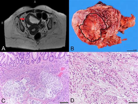 Gastric Adenocarcinoma Arising In Gastrocystoplasty Urology