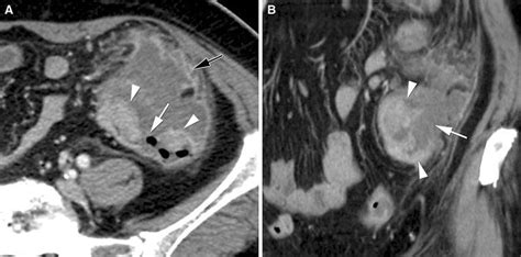 Perforated Adenocarcinoma In The Sigmoid Colon Of A 72 Year Old Woman Download Scientific