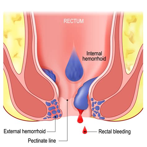 Hemorrhoidal Artery Embolization Hae Diagnosis And Treatment