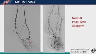 Angiographic Anatomy Of BTK Vessels And Pedal Plantar Loop Doovi