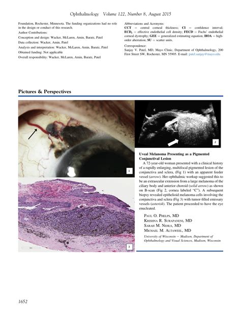 PDF Uveal Melanoma Presenting As A Pigmented Conjunctival Lesion