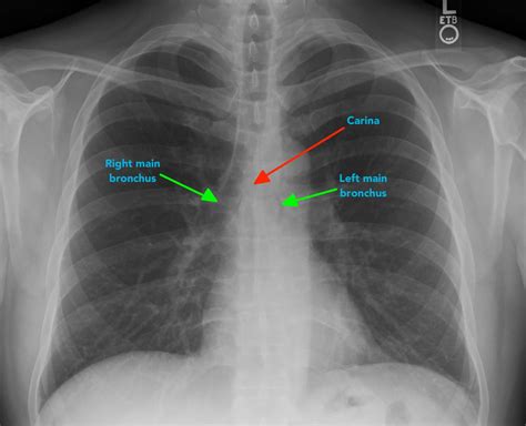 Chest X-ray Interpretation | A Structured Approach | Radiology | OSCE