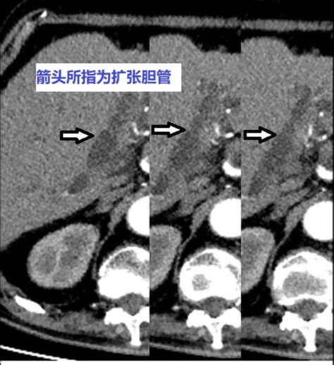 医疗速递 胆总管结石引发感染性休克，ptcd术为八旬老人疏通“生命之路” 医疗速递 青岛市妇女儿童医院 青岛大学附属妇儿医院