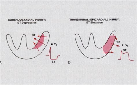 STEMI Flashcards | Quizlet