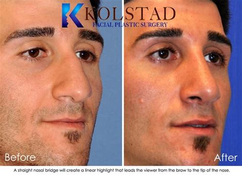 Nasal Tip Ptosis Nose Job For Men Before And After Gallery 19 Dr