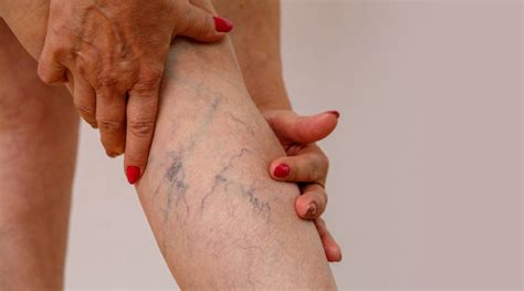 Laser Treatment For Varicose Veins At Laser Piles Clinic