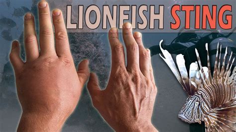 Scuba Diver Stung By Venomous Lionfish Spines On Camera Youtube