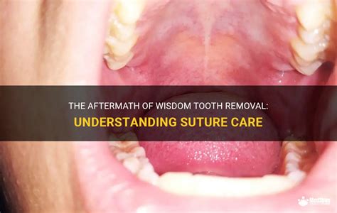 The Aftermath Of Wisdom Tooth Removal Understanding Suture Care Medshun