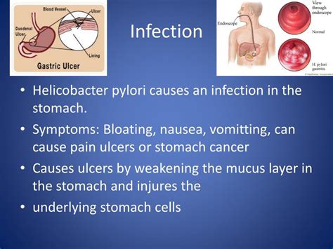 Ppt Helicobacter Pylori Powerpoint Presentation Free Download Id