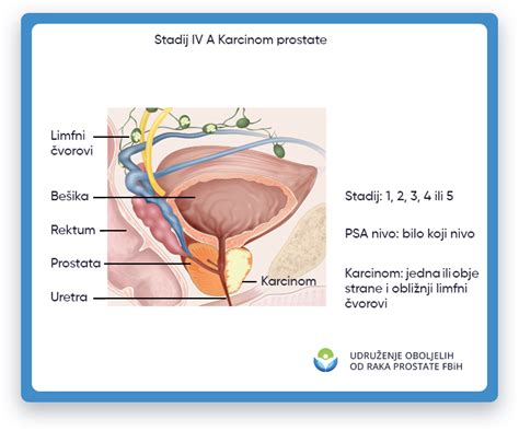 Lije Enje Karcinoma Prostate Uorp