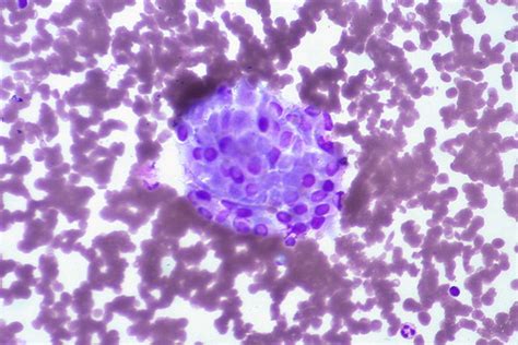 Papillary Carcinoma Of Thyroid Fna This Giemsa Prep Shows Flickr