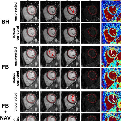 Spatial Variability Of T2 Mapping In All Subjects Using The T2p20te