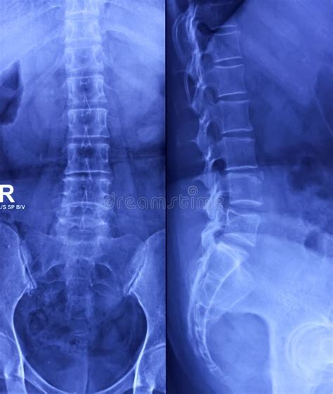 Lumbar Vertebra Lateral View The Best Porn Website