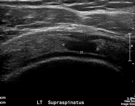 Rotator Cuff Undergraduate Diagnostic Imaging Fundamentals