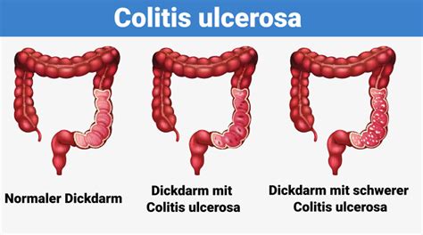 Colitis ulcerosa CED Informationen Hilfe ÁYIO Q