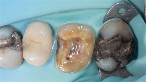 Adhesieve Hechting Aan Het Endodontisch Behandelde Gebitselement NTVT