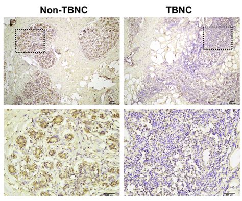 Immunohistochemistry Analysis Of Lifr Protein In Human Tnbc Tissues