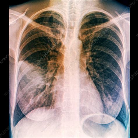 lungs  pneumonia  ray stock image  science photo library