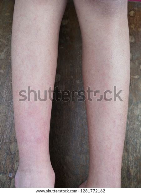 Viral Rash Exanthem Child Stock Photo 1281772162 | Shutterstock