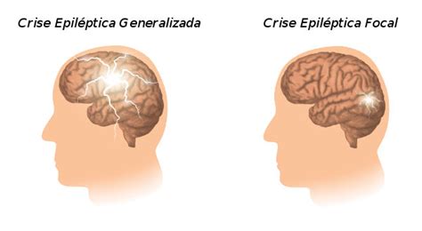 Convulsão o que é causas como proceder Mundo Educação